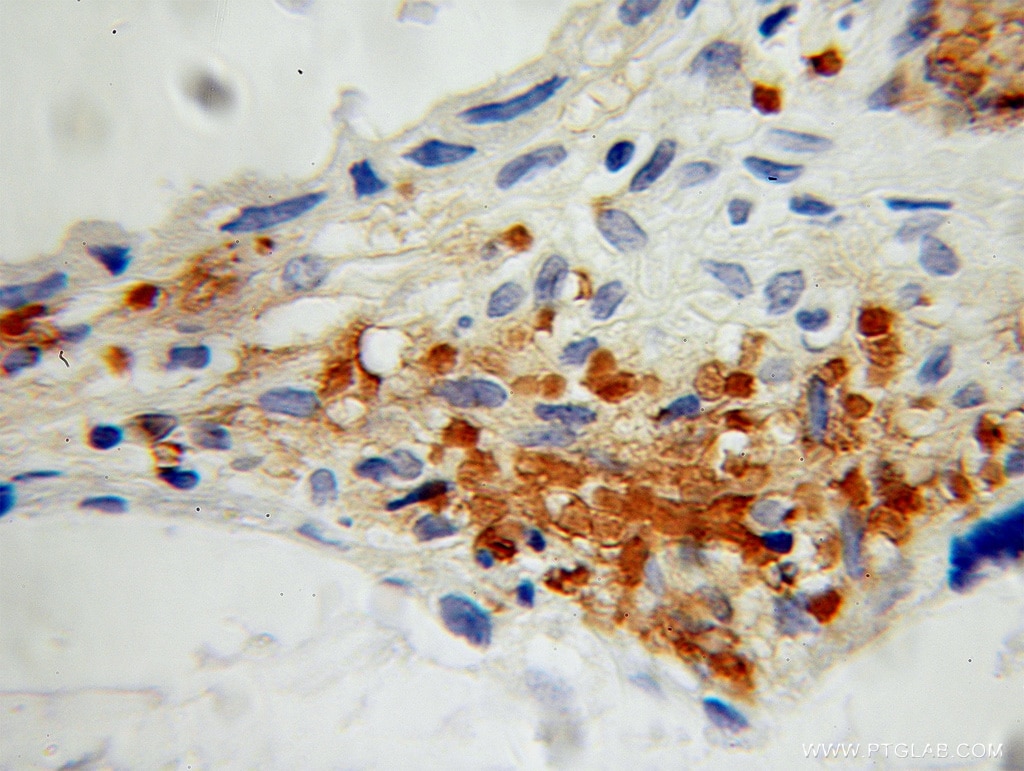Immunohistochemistry (IHC) staining of human ovary tumor tissue using SIVA1 Polyclonal antibody (12992-1-AP)