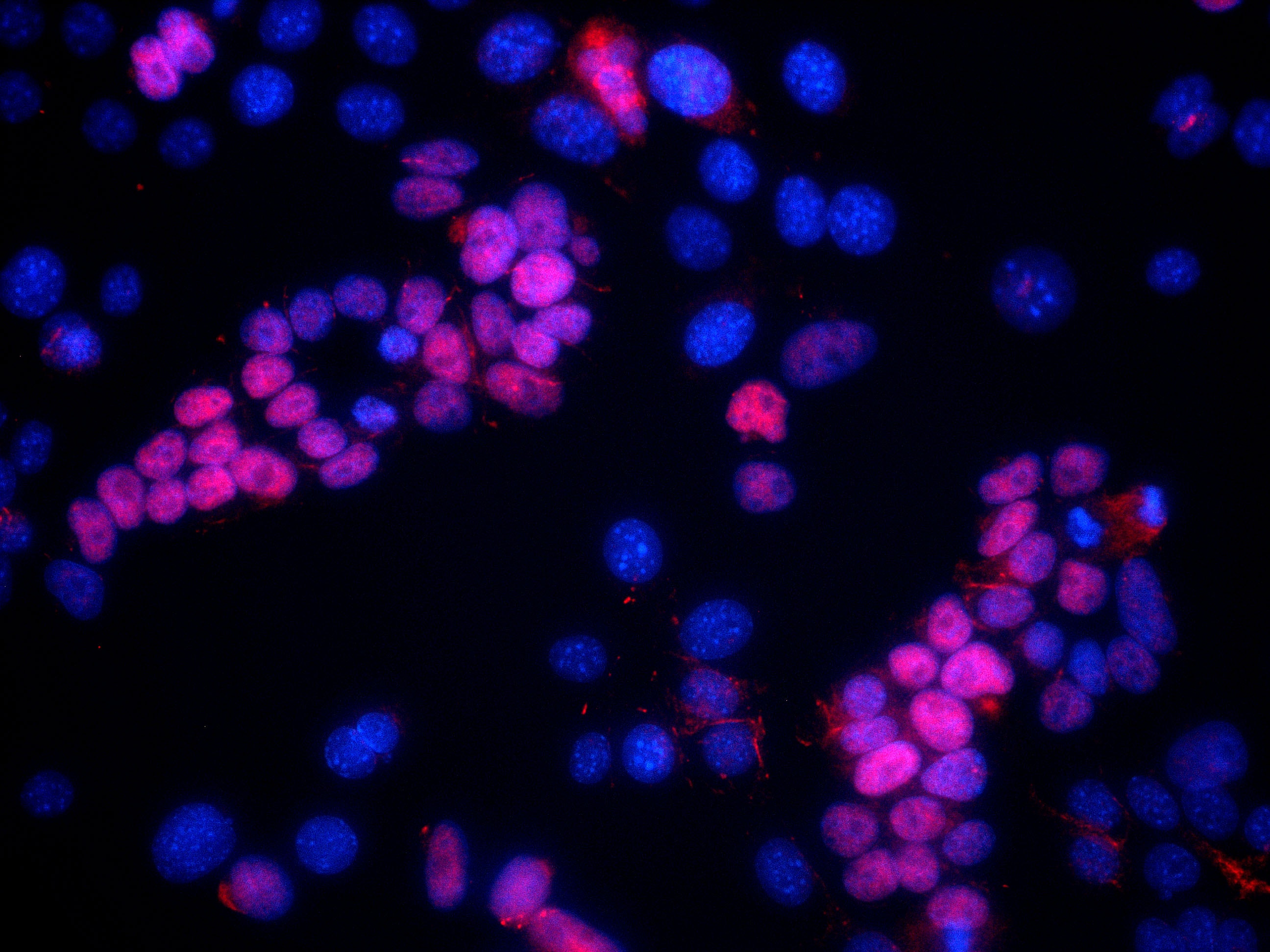 Immunofluorescence (IF) / fluorescent staining of epithelial tumor cells using SIX1 Polyclonal antibody (10709-1-AP)