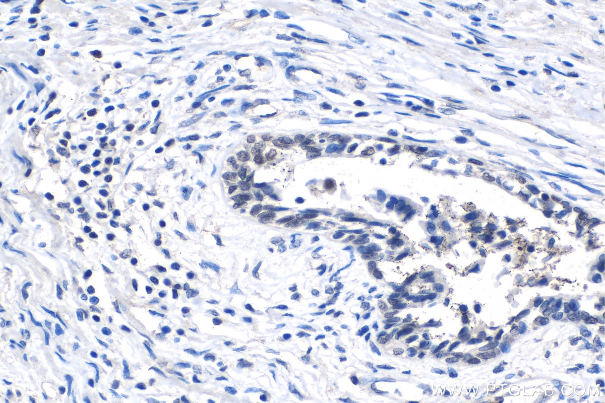 IHC staining of human prostate cancer using 67741-1-Ig Immunohistochemistry (IHC) staining of human prostate cancer tissue using SIX1 Monoclonal antibody (67741-1-Ig)