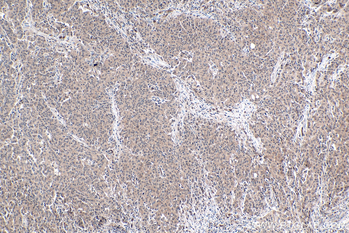 IHC staining of human stomach cancer using 67741-1-Ig Immunohistochemistry (IHC) staining of human stomach cancer tissue using SIX1 Monoclonal antibody (67741-1-Ig)