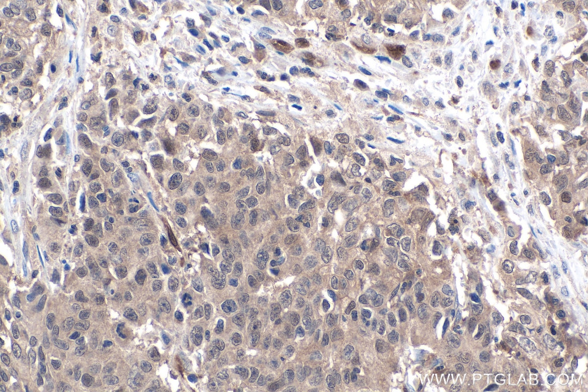 IHC staining of human stomach cancer using 67741-1-Ig Immunohistochemistry (IHC) staining of human stomach cancer tissue using SIX1 Monoclonal antibody (67741-1-Ig)