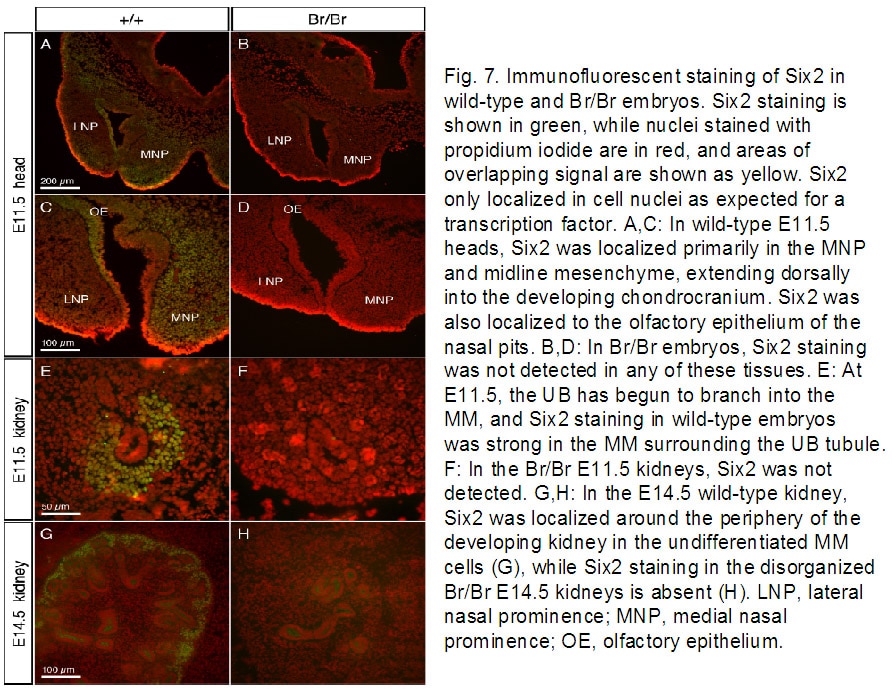 Immunofluorescence (IF) / fluorescent staining of heritable frontonasal dysplasia and renal hypoplas using SIX2 Polyclonal antibody (11562-1-AP)