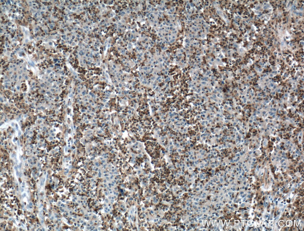 Immunohistochemistry (IHC) staining of human colon cancer tissue using SKAP2 Polyclonal antibody (12926-1-AP)