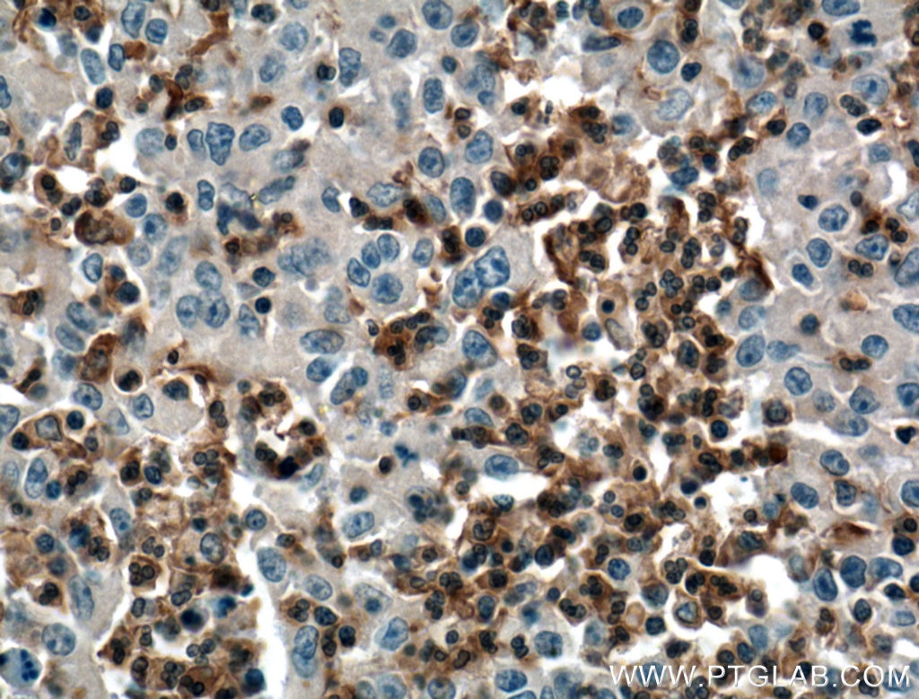 Immunohistochemistry (IHC) staining of human colon cancer tissue using SKAP2 Polyclonal antibody (12926-1-AP)