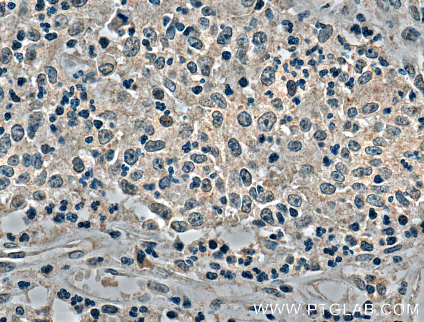 Immunohistochemistry (IHC) staining of human colon cancer tissue using SKAP2 Monoclonal antibody (66367-1-Ig)