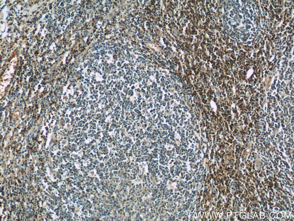 Immunohistochemistry (IHC) staining of human tonsillitis tissue using SKAP55 Polyclonal antibody (14724-1-AP)