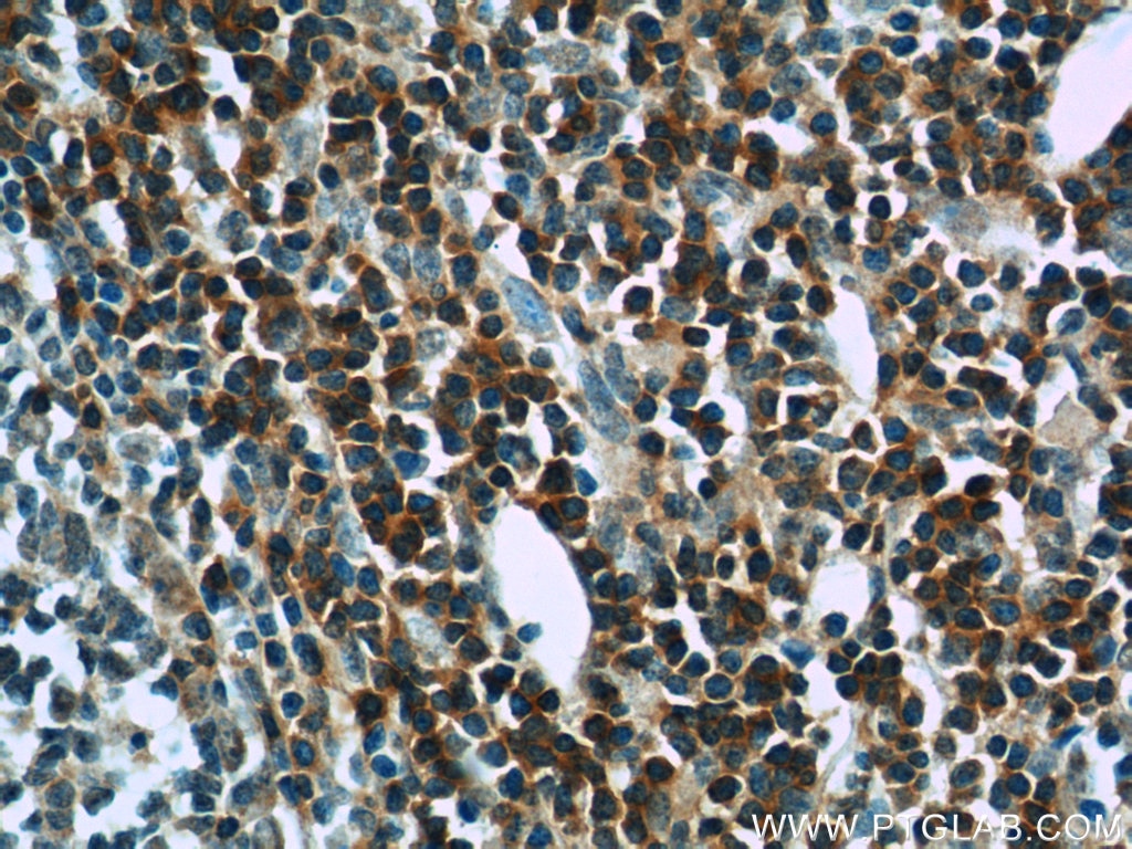 Immunohistochemistry (IHC) staining of human tonsillitis tissue using SKAP55 Polyclonal antibody (14724-1-AP)