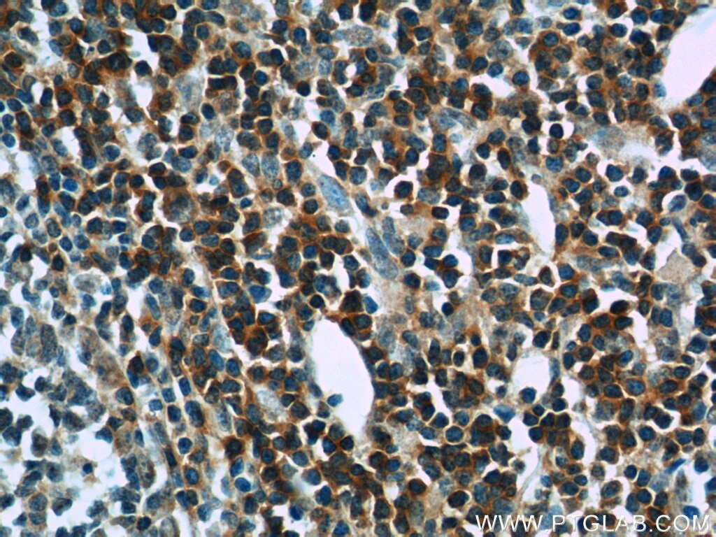 IHC staining of human tonsillitis using 14724-1-AP