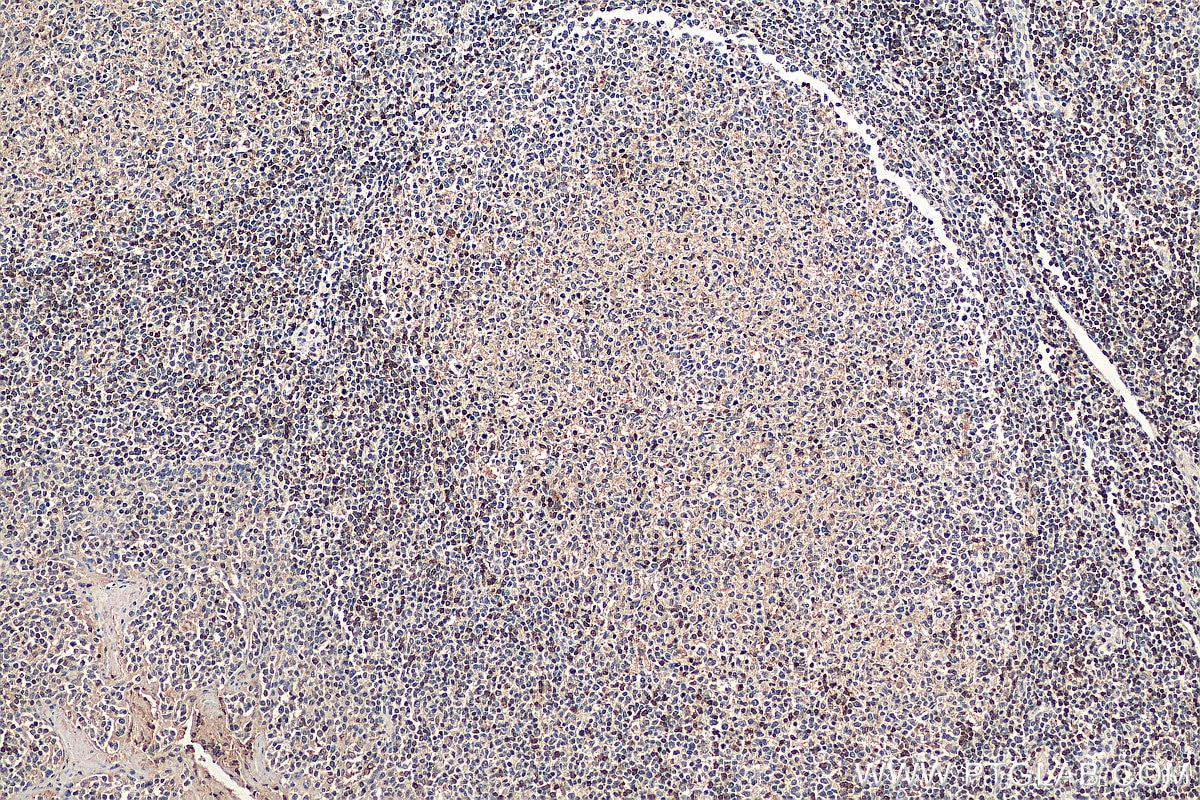 Immunohistochemistry (IHC) staining of human tonsillitis tissue using SKAP55 Polyclonal antibody (19247-1-AP)