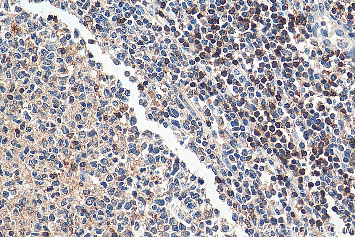 Immunohistochemistry (IHC) staining of human tonsillitis tissue using SKAP55 Polyclonal antibody (19247-1-AP)