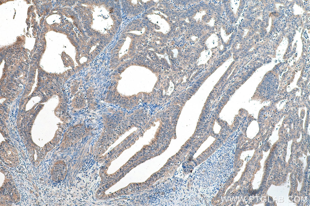 Immunohistochemistry (IHC) staining of human endometrial cancer tissue using SKIL Polyclonal antibody (19218-1-AP)