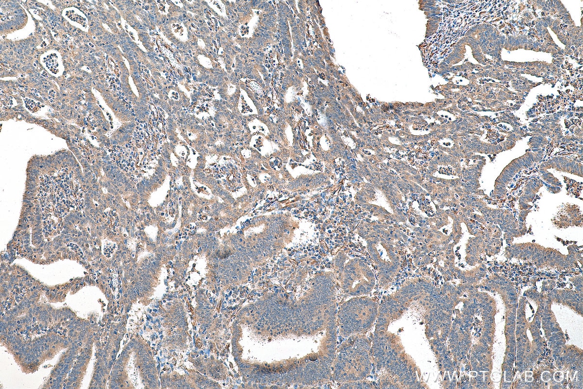 IHC staining of human endometrial cancer using 19218-1-AP