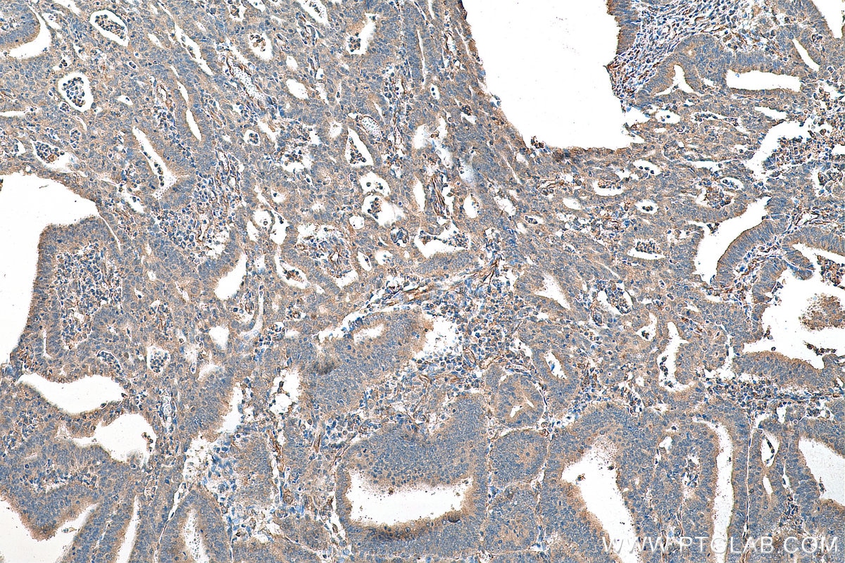 Immunohistochemistry (IHC) staining of human endometrial cancer tissue using SKIL Polyclonal antibody (19218-1-AP)