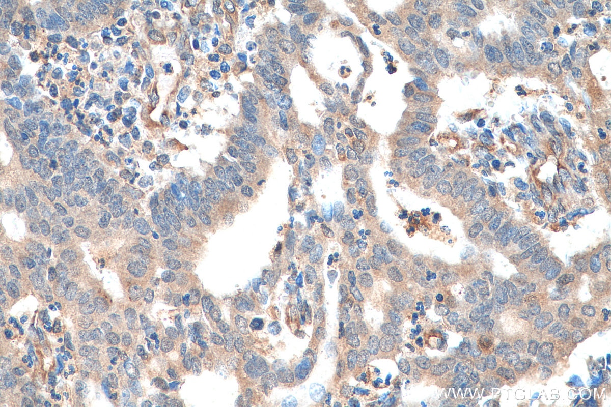 Immunohistochemistry (IHC) staining of human endometrial cancer tissue using SKIL Polyclonal antibody (19218-1-AP)