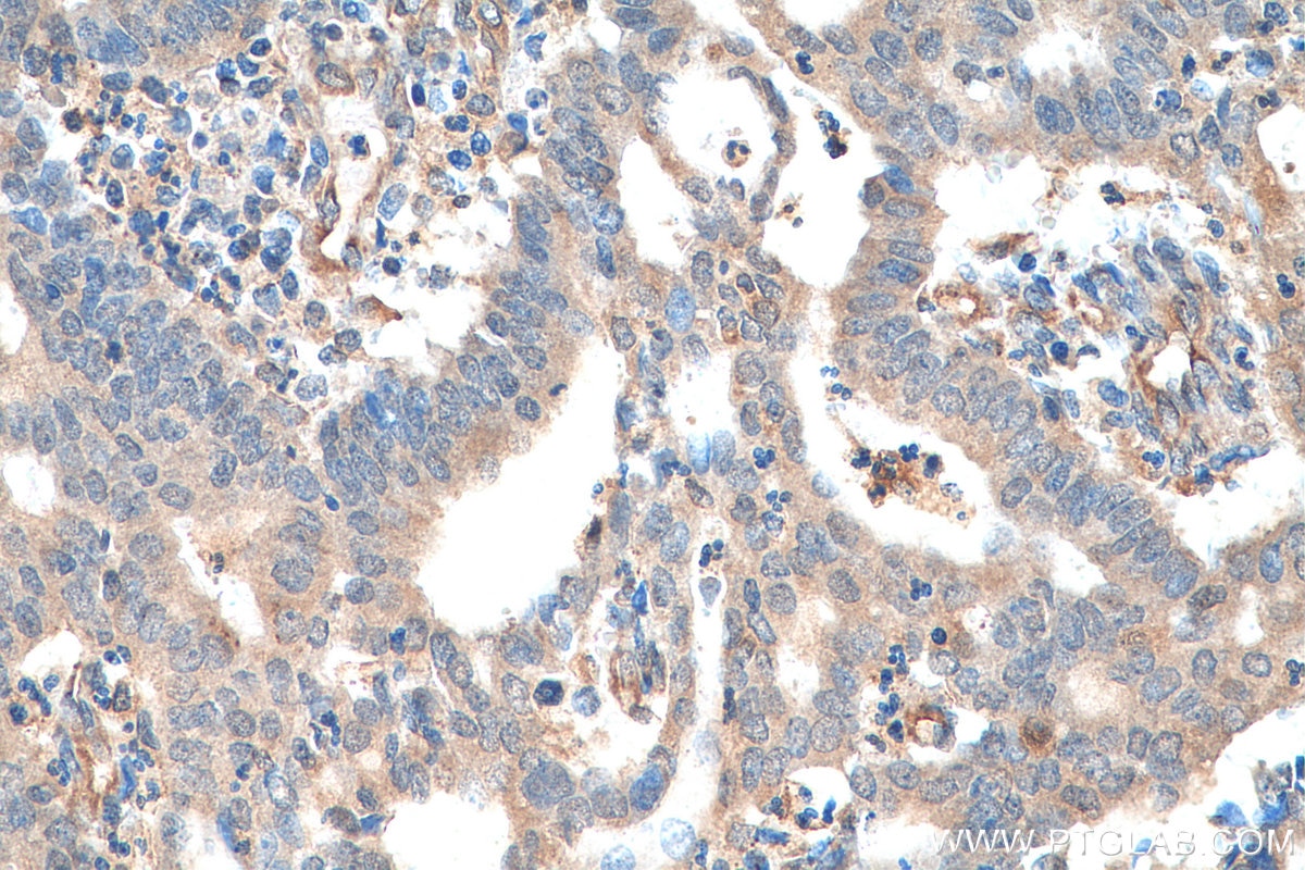 IHC staining of human endometrial cancer using 19218-1-AP