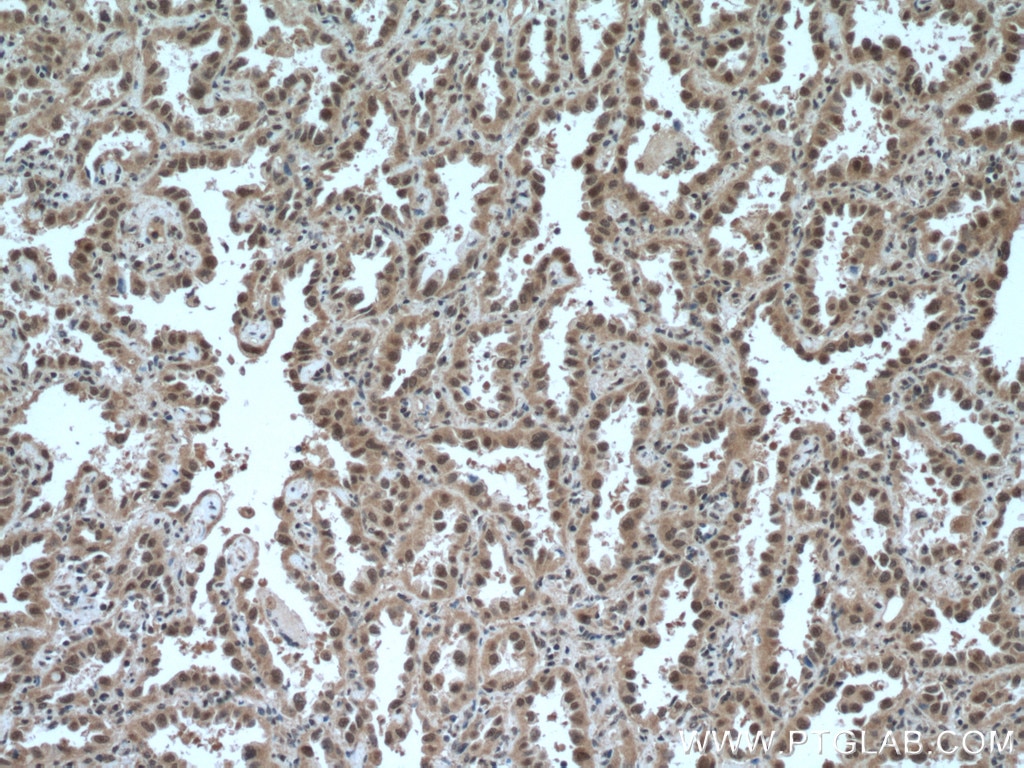 Immunohistochemistry (IHC) staining of human lung cancer tissue using SKP1 Polyclonal antibody (10990-2-AP)