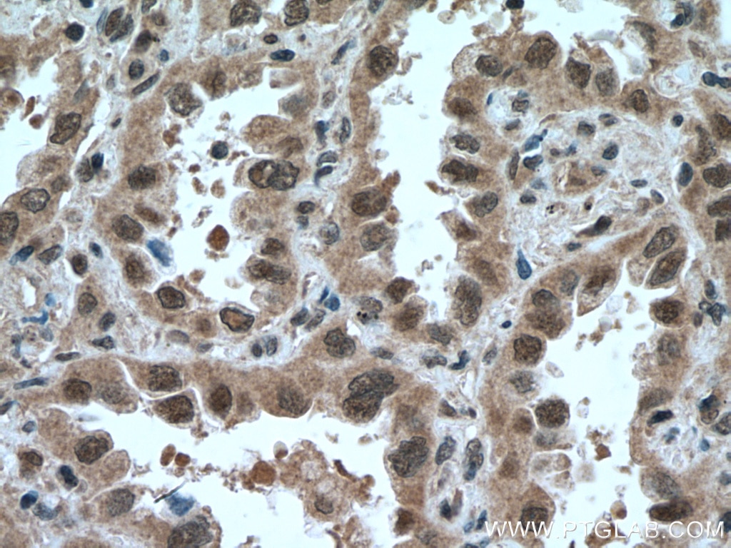 Immunohistochemistry (IHC) staining of human lung cancer tissue using SKP1 Polyclonal antibody (10990-2-AP)