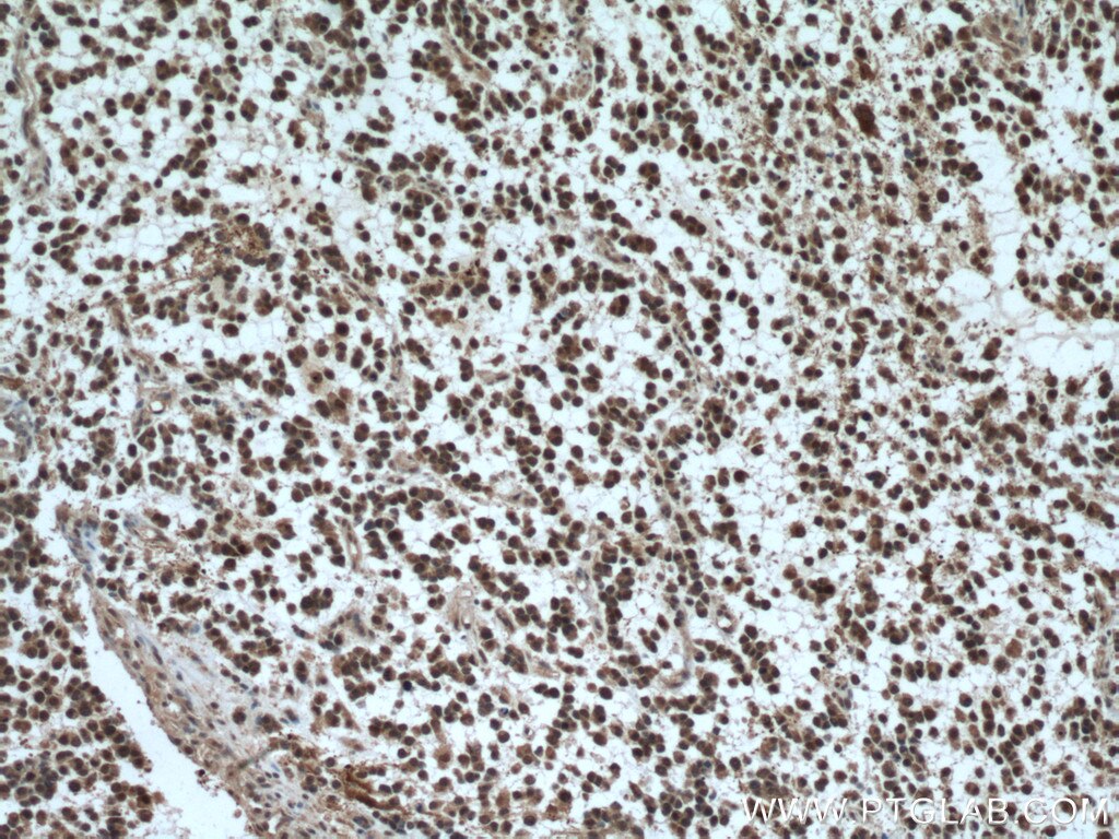 Immunohistochemistry (IHC) staining of human gliomas tissue using SKP1 Polyclonal antibody (10990-2-AP)