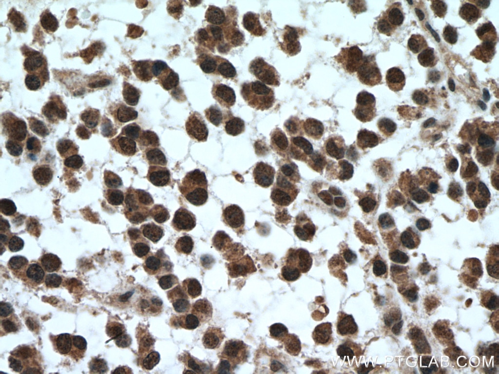 Immunohistochemistry (IHC) staining of human gliomas tissue using SKP1 Polyclonal antibody (10990-2-AP)