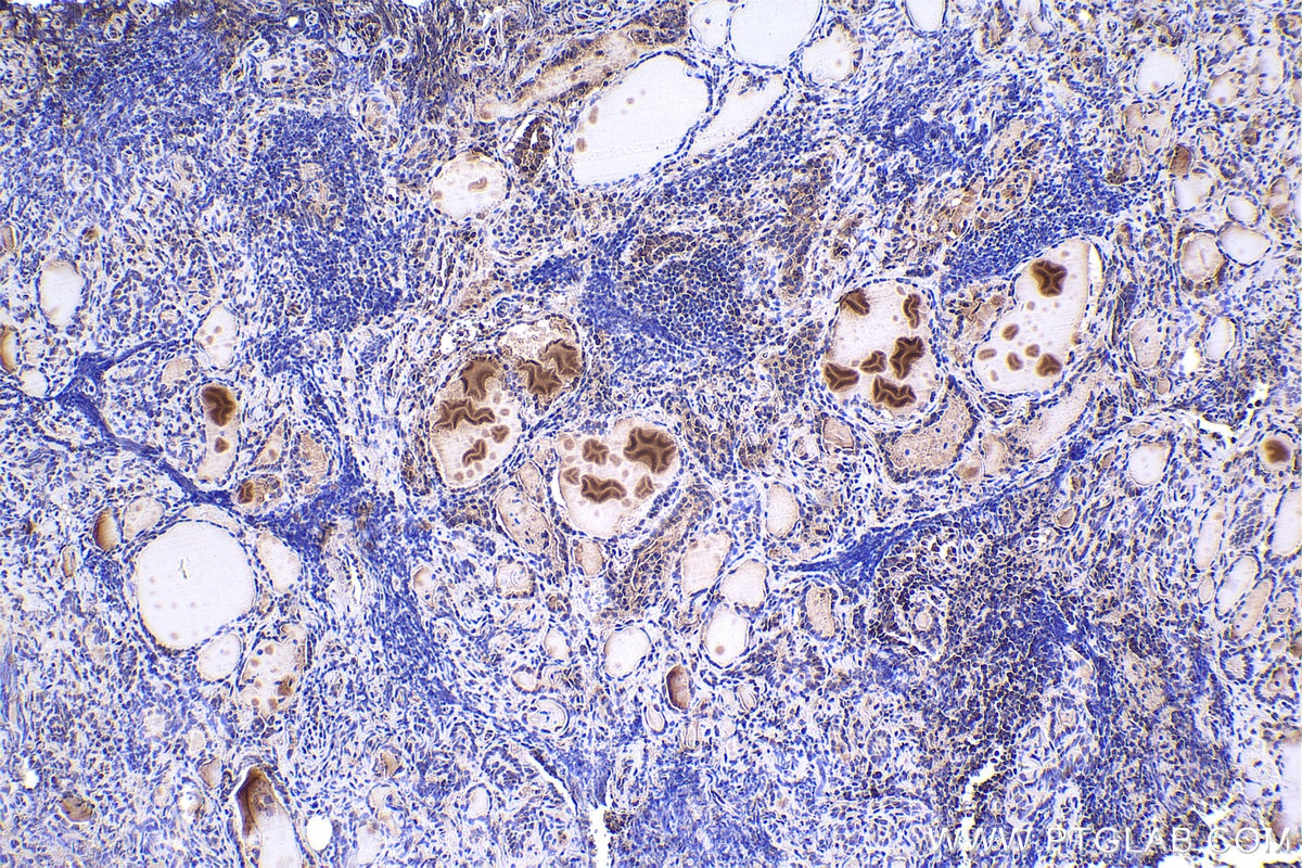 IHC staining of human thyroid cancer using 67745-1-Ig Immunohistochemistry (IHC) staining of human thyroid cancer tissue using SKP1 Monoclonal antibody (67745-1-Ig)