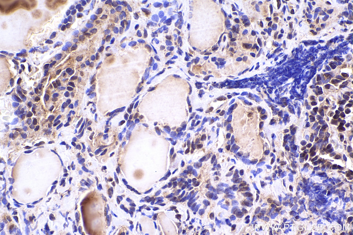 IHC staining of human thyroid cancer using 67745-1-Ig Immunohistochemistry (IHC) staining of human thyroid cancer tissue using SKP1 Monoclonal antibody (67745-1-Ig)