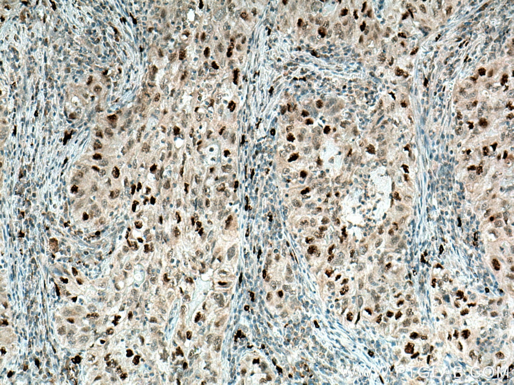 Immunohistochemistry (IHC) staining of human lung cancer tissue using SKP2 Polyclonal antibody (15010-1-AP)