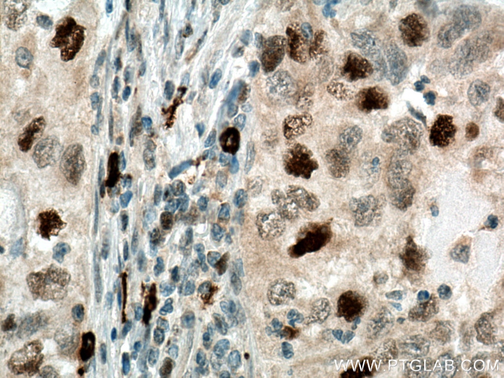 Immunohistochemistry (IHC) staining of human lung cancer tissue using SKP2 Polyclonal antibody (15010-1-AP)