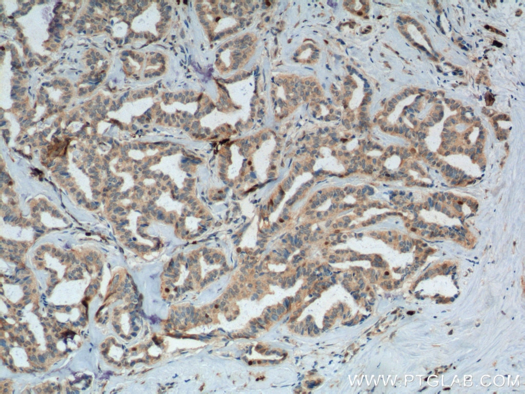 Immunohistochemistry (IHC) staining of human breast cancer tissue using SKP2 Polyclonal antibody (15010-1-AP)