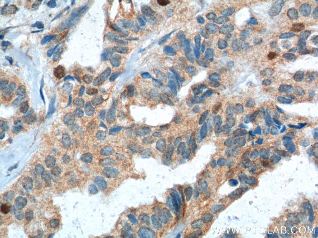Immunohistochemistry (IHC) staining of human breast cancer tissue using SKP2 Polyclonal antibody (15010-1-AP)
