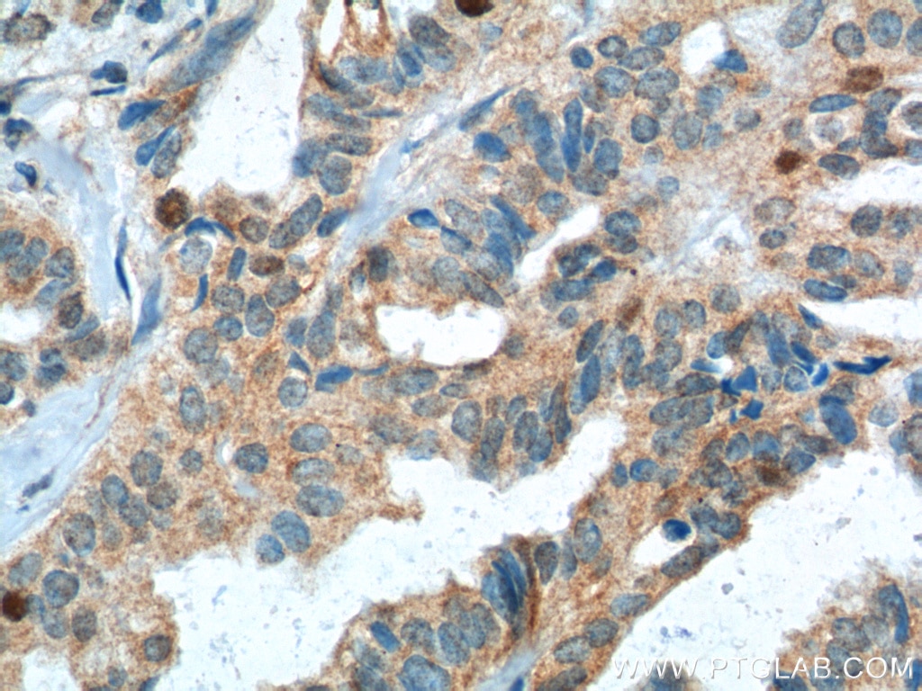 IHC staining of human breast cancer using 15010-1-AP