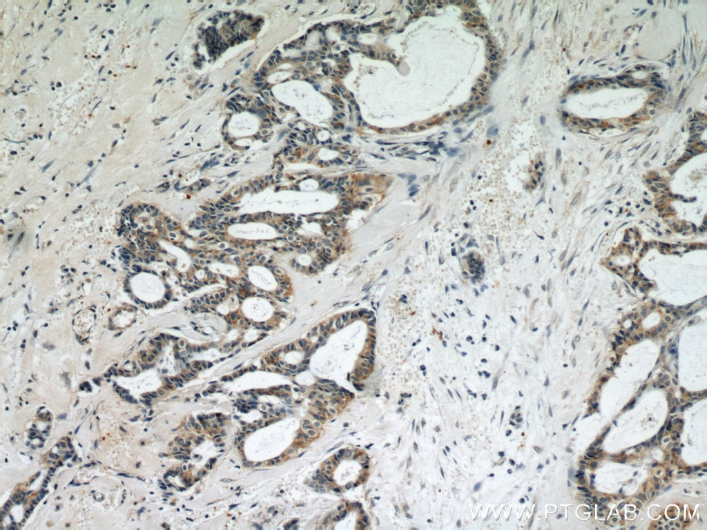 IHC staining of human breast cancer using 15010-1-AP