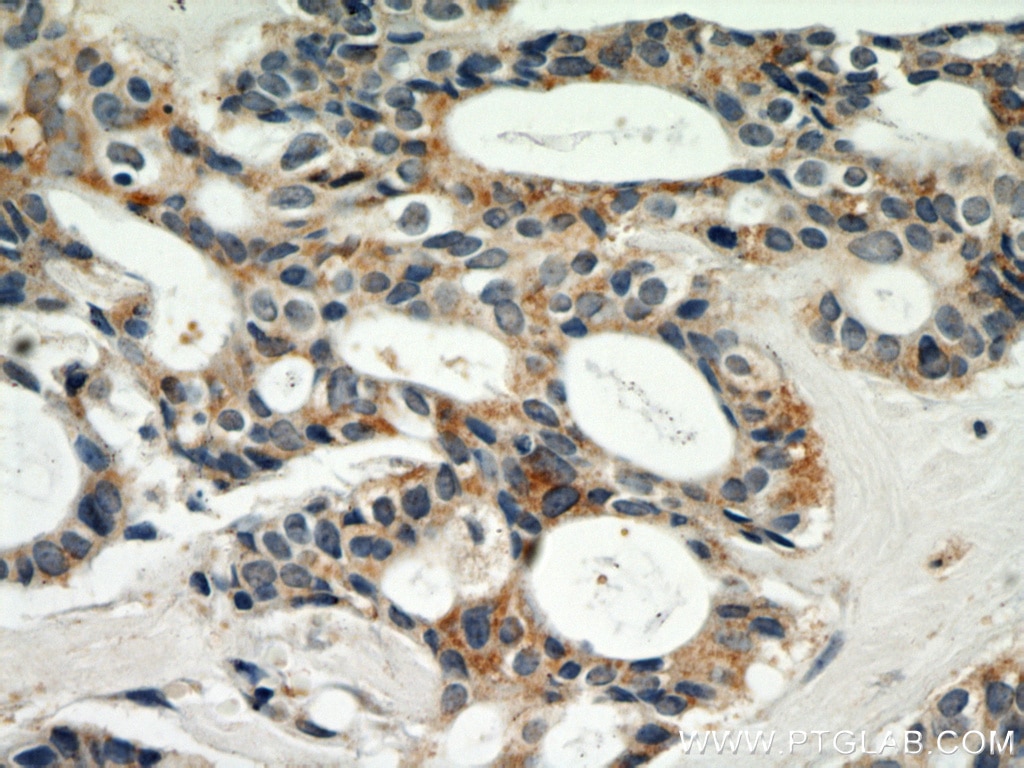 Immunohistochemistry (IHC) staining of human breast cancer tissue using SKP2 Polyclonal antibody (15010-1-AP)