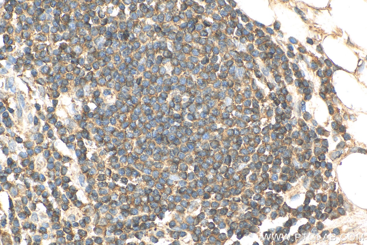 Immunohistochemistry (IHC) staining of human colon cancer tissue using SLAMF6 Polyclonal antibody (22711-1-AP)