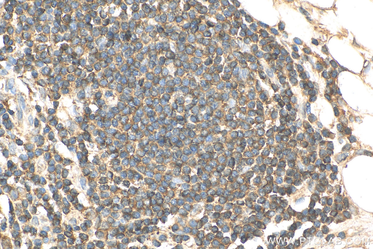 IHC staining of human colon cancer using 22711-1-AP