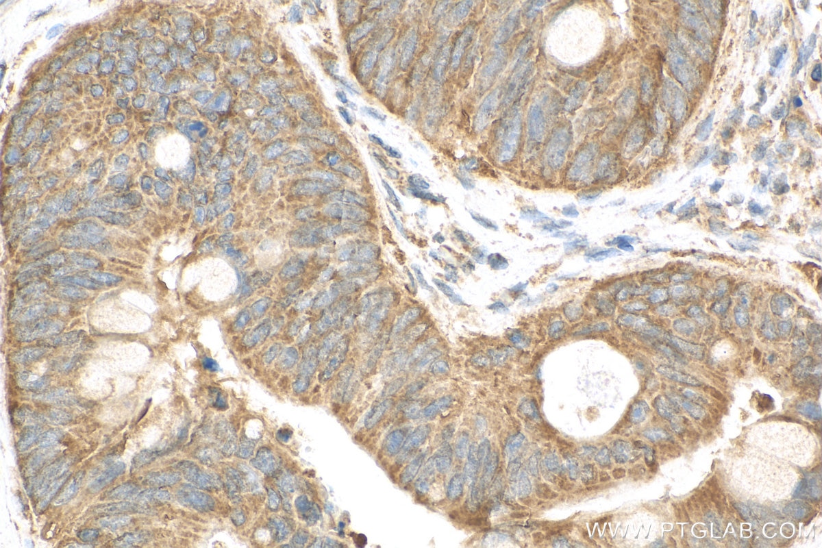 Immunohistochemistry (IHC) staining of human colon cancer tissue using SLAMF6 Polyclonal antibody (22711-1-AP)