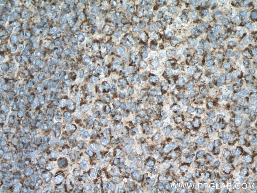 Immunohistochemistry (IHC) staining of human tonsillitis tissue using SLAMF6 Polyclonal antibody (22711-1-AP)