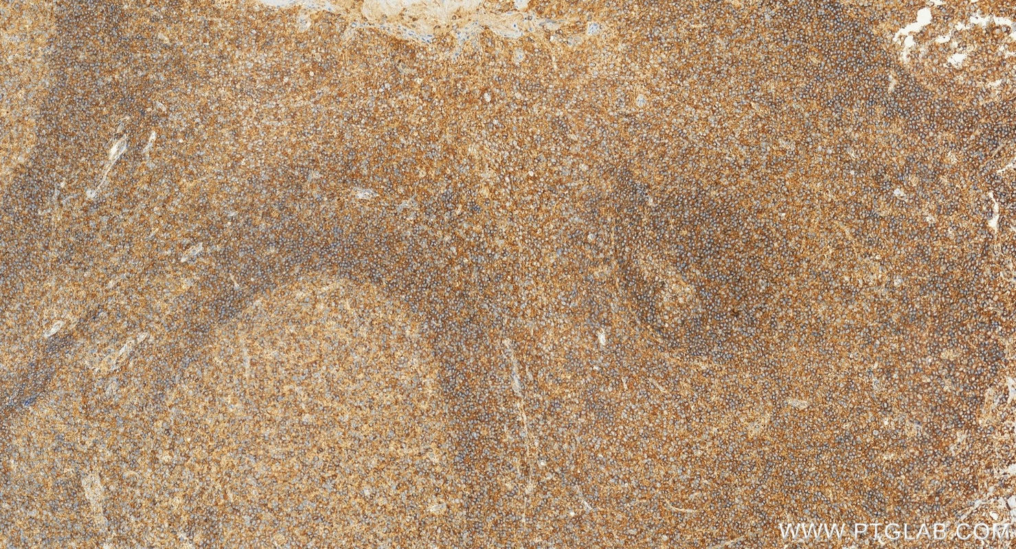 Immunohistochemistry (IHC) staining of human tonsillitis tissue using NTB-A/SLAMF6 Polyclonal antibody (22711-1-AP)