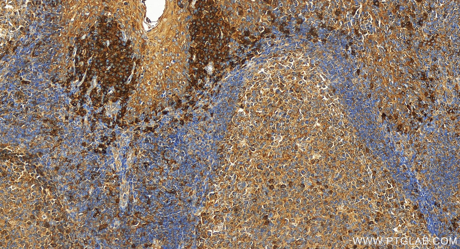 Immunohistochemistry (IHC) staining of human tonsillitis tissue using SLAMF7/CD319 Polyclonal antibody (12905-1-AP)