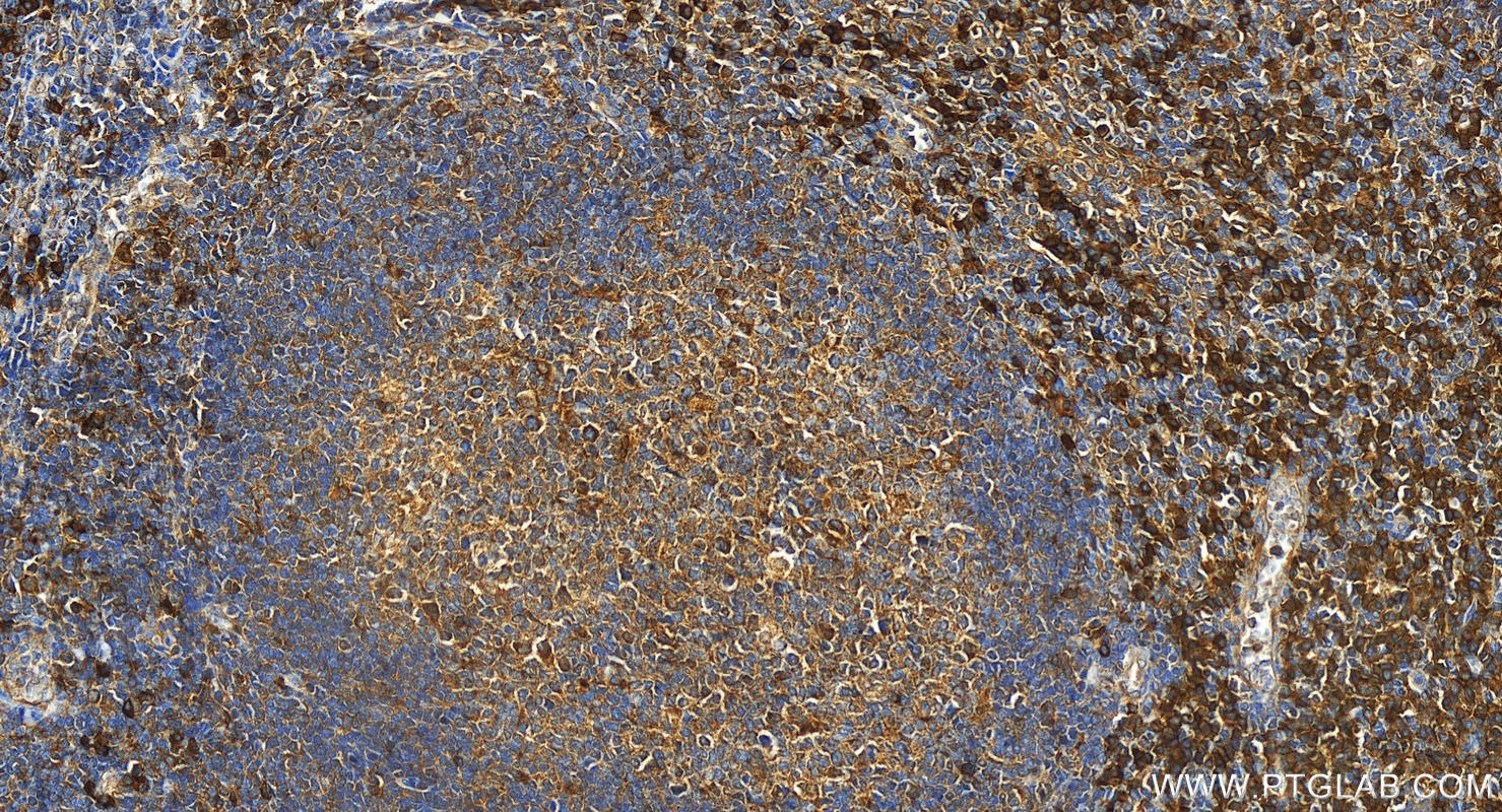 Immunohistochemistry (IHC) staining of human tonsillitis tissue using SLAMF7/CD319 Polyclonal antibody (12905-1-AP)