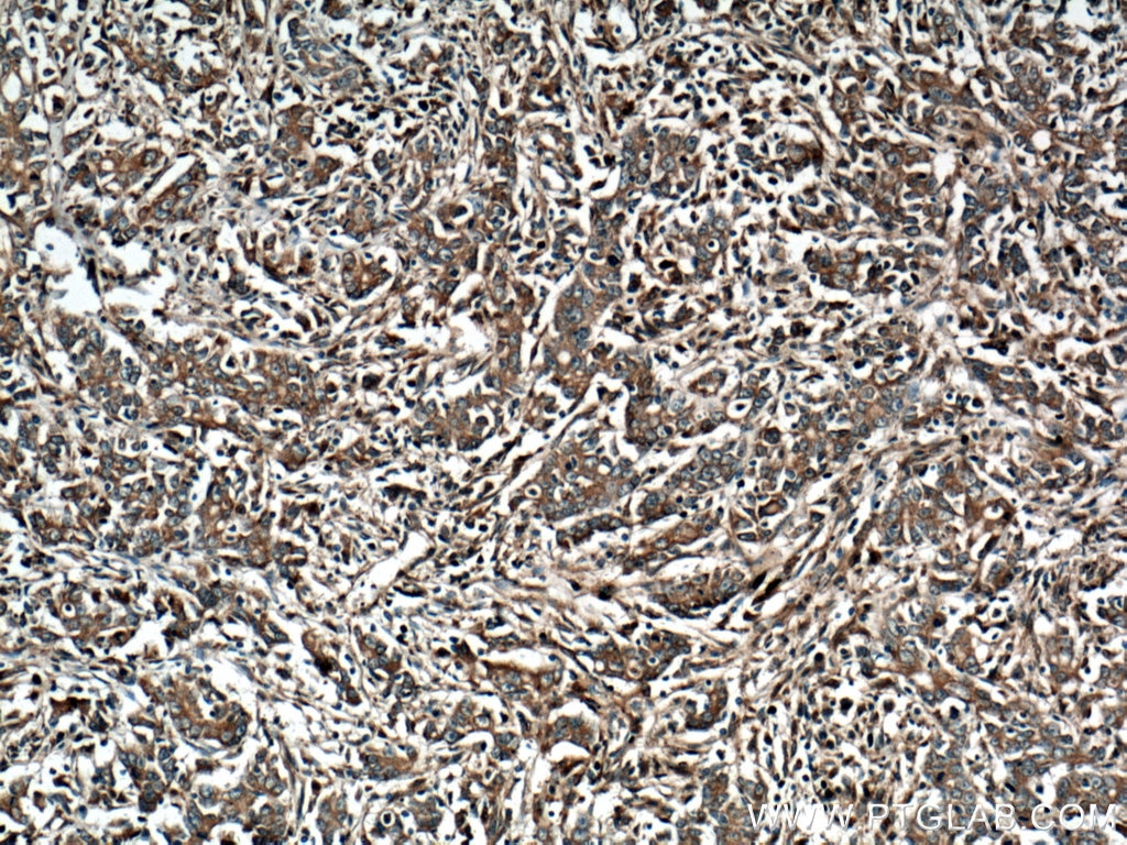 Immunohistochemistry (IHC) staining of human stomach cancer tissue using SLC10A6 Polyclonal antibody (27938-1-AP)