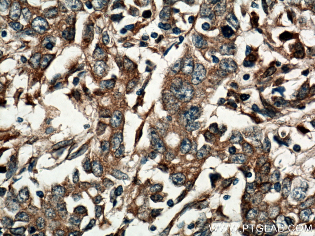 Immunohistochemistry (IHC) staining of human stomach cancer tissue using SLC10A6 Polyclonal antibody (27938-1-AP)