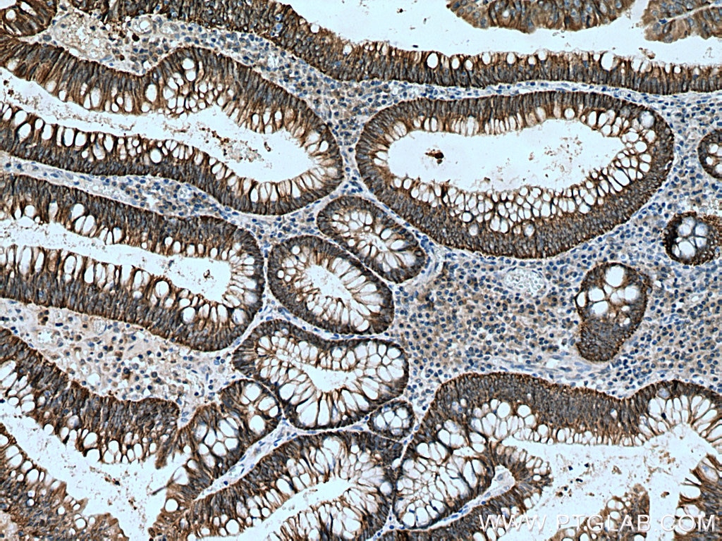 IHC staining of human colon cancer using 13884-1-AP