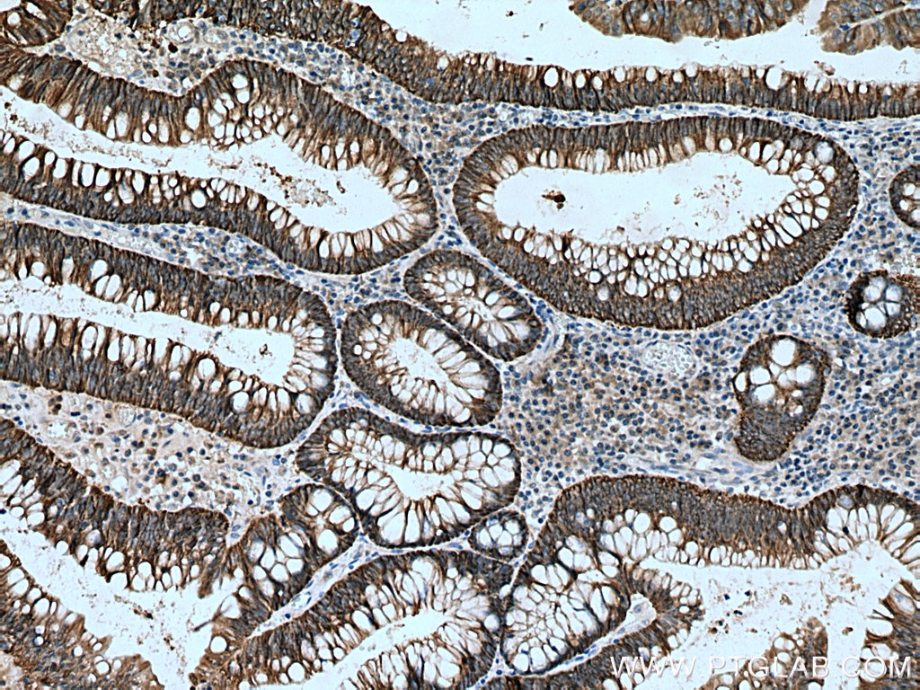 Immunohistochemistry (IHC) staining of human colon cancer tissue using NKCC1,SLC12A2 Polyclonal antibody (13884-1-AP)