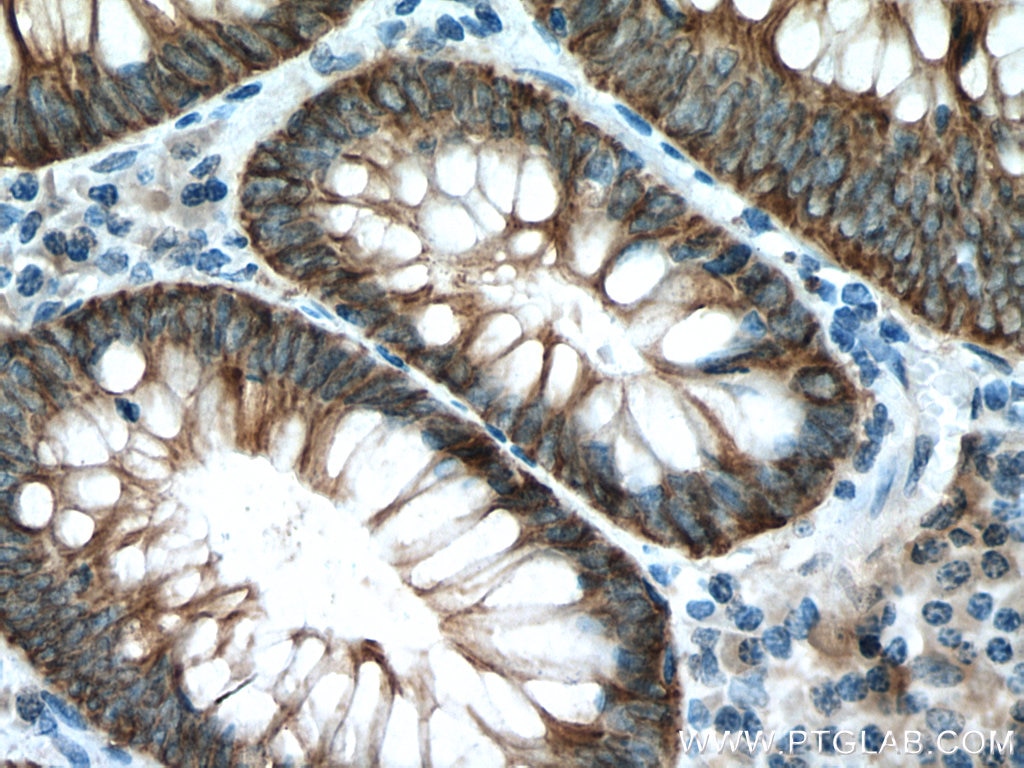 Immunohistochemistry (IHC) staining of human colon cancer tissue using NKCC1,SLC12A2 Polyclonal antibody (13884-1-AP)