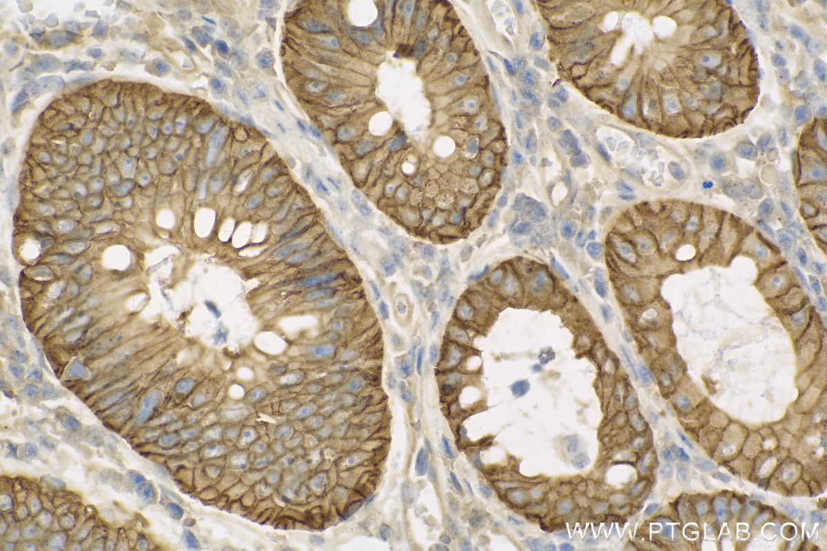 Immunohistochemistry (IHC) staining of human colon cancer tissue using NKCC1,SLC12A2 Polyclonal antibody (13884-1-AP)