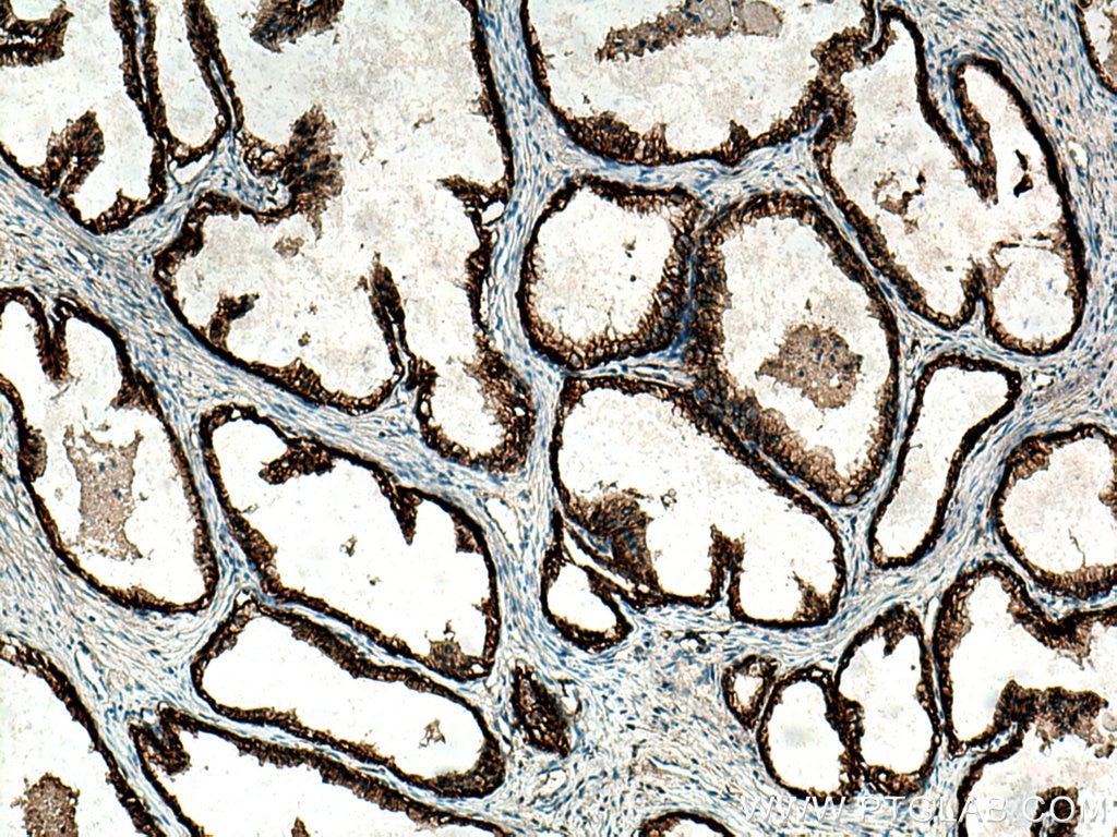 IHC staining of human prostate cancer using 28055-1-AP