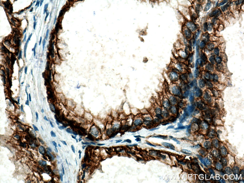 Immunohistochemistry (IHC) staining of human prostate cancer tissue using NKCC1,SLC12A2 Polyclonal antibody (28055-1-AP)