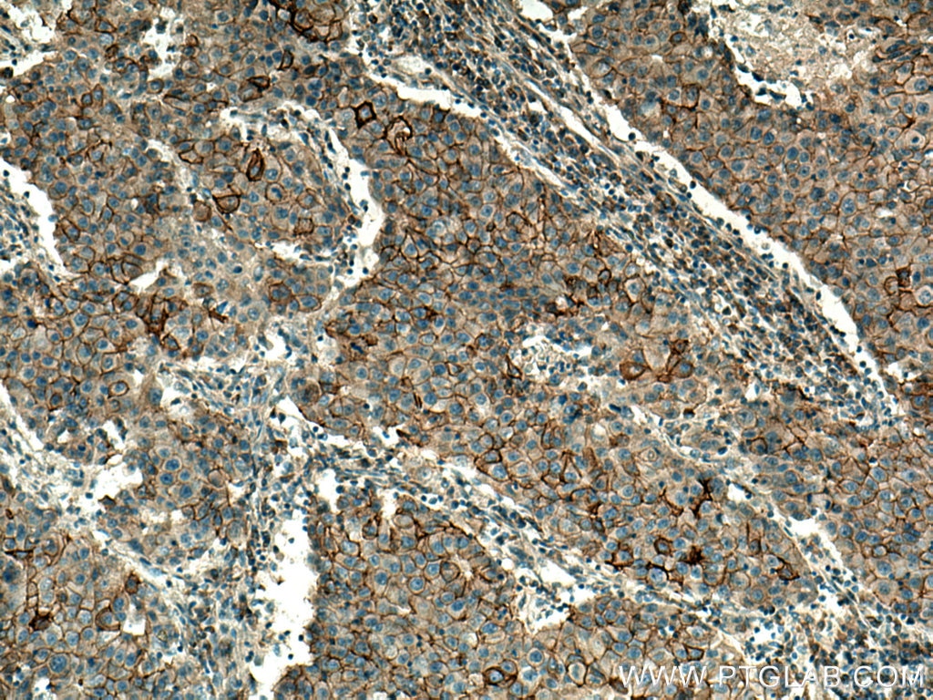 Immunohistochemistry (IHC) staining of human breast cancer tissue using NKCC1,SLC12A2 Polyclonal antibody (28055-1-AP)