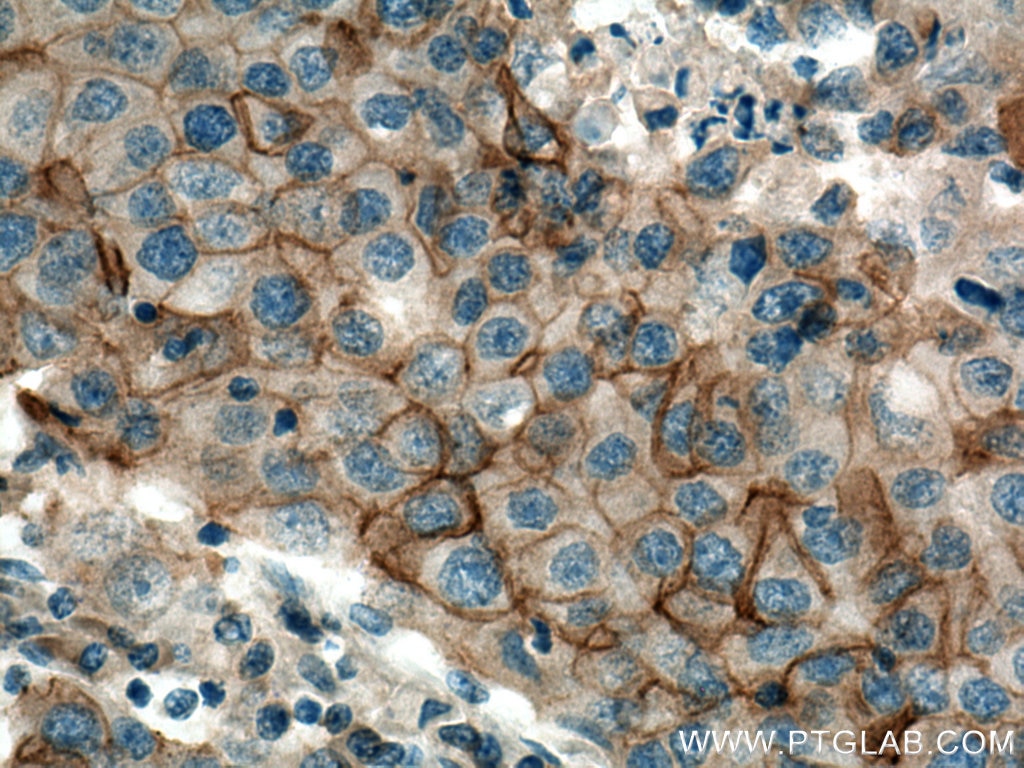 Immunohistochemistry (IHC) staining of human breast cancer tissue using NKCC1,SLC12A2 Polyclonal antibody (28055-1-AP)