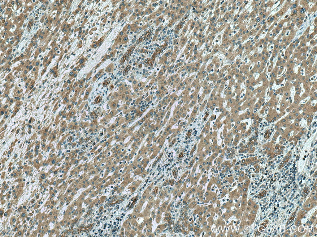 Immunohistochemistry (IHC) staining of human liver cancer tissue using SLC12A4 Polyclonal antibody (15927-1-AP)